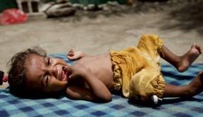 Açlıkla Mücadele Eden Çocukların Karnı Neden Şişer?